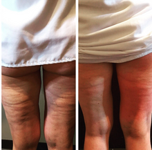 Load image into Gallery viewer, Before and after results of a customer doing a Cryo Lifting session. Cryo Lifting tightens, tones, and firms loose skin.