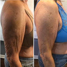 Load image into Gallery viewer, Before and after results of a customer doing a Cryo Lifting session. Cryo Lifting tightens, tones, and firms loose skin.