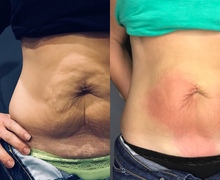 Load image into Gallery viewer, Before and after results of a customer doing a Cryo Lifting session. Cryo Lifting tightens, tones, and firms loose skin.