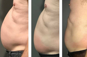 Before and after results of a male customer doing Cryo Slimming. Cryo Slimming eliminates fat instantly and permanently.