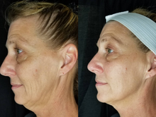 Load image into Gallery viewer, Before and after results of a customer doing Cryo Lifting Facials. Lifting Facials are a natural and non invasive facelift.