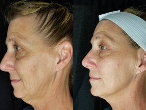 Before and after results of a customer doing Cryo Lifting Facials. Lifting Facials are a natural and non invasive facelift.