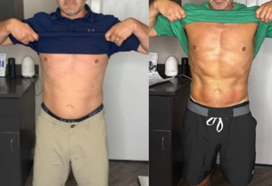 Before and after results of a male customer doing Cryo Slimming. Cryo Slimming eliminates fat instantly and permanently.