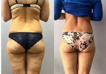 Load image into Gallery viewer, Before and after results of a customer doing Endospheres. Endospheres reduces cellulite, tightens, tones, and firms the skin.