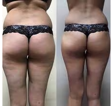 Load image into Gallery viewer, Before and after results of a customer doing Endospheres. Endospheres reduces cellulite, tightens, tones, and firms the skin.