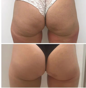 Before and after results of a customer doing Endospheres. Endospheres reduces cellulite, tightens, tones, and firms the skin.