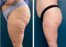 Load image into Gallery viewer, Before and after results of a customer doing Endospheres. Endospheres reduces cellulite, tightens, tones, and firms the skin.