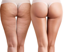 Load image into Gallery viewer, Before and after results of a customer doing Endospheres. Endospheres reduces cellulite, tightens, tones, and firms the skin.