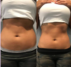 Cryo Slimming