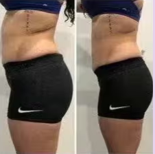 Cryo Slimming